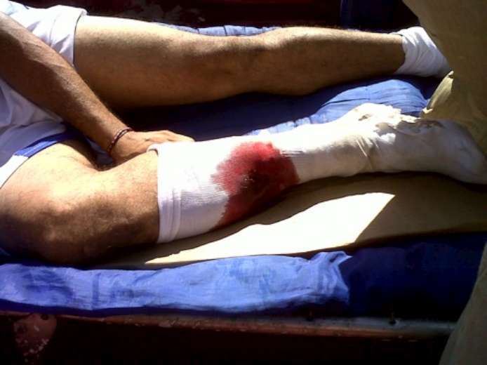 Jugando Futbol Sufrió una Fractura Expuesta en el Colomo no Había Ambulancia en PC