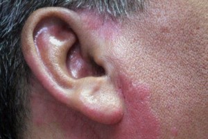 Psoriasis afecta desde la infancia