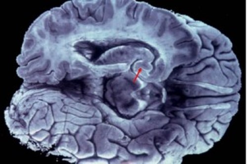Retos para abordar el alzheimer
