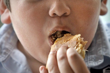 Proponen ‘reducir’ estómago a niños obesos