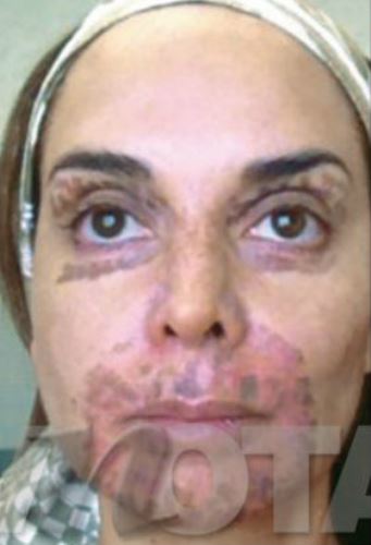 Le queman el rostro a Lupita Jones