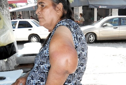 Operaciones mal Hechas le Deformaron su Brazo Hace 12 Años y no Sana